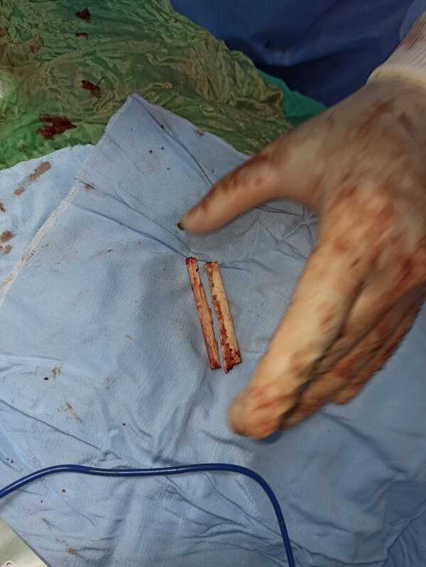 صحة الشرقية: استئصال ورم سرطاني متشعب لطفلة بمستشفى السعديين المركزي