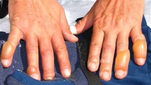 أستاذ الأوعية الدموية بكلية قصر العيني: يحذر من تجمد الأطراف بسبب برودة الطقس