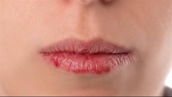 شفاه جافة رغم استخدام المرطب؟| احذر هذه العادات