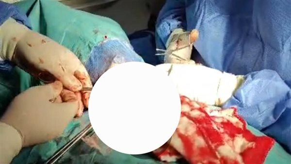 إنجاز طبي جديد في بلبيس.. نجاح جراحة دقيقة لاستئصال الغدة الدرقية التسممية