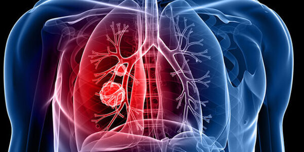 دراسة: أورام سرطانية بالرئة لا تشكل خطرا