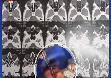 مستشفى طب وجراحة العيون “رمد الزقازيق”: تنجح في استخراج قلم من عين طفل